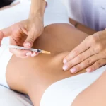 Carboxiterapia: de qué trata y por qué se combina con Accent corporal